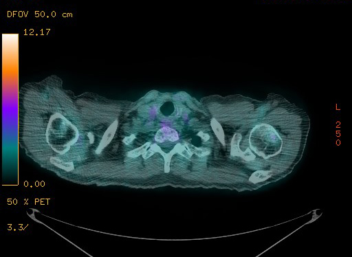 Appendiceal adenocarcinoma complicated by retroperitoneal abscess (Radiopaedia 58007-65041 Axial PET-CT 29).jpg