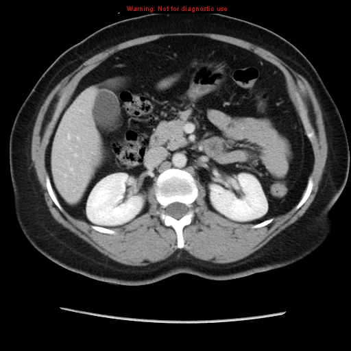 Appendiceal mucinous cystadenoma (Radiopaedia 8263-9111 Axial liver window 33).jpg