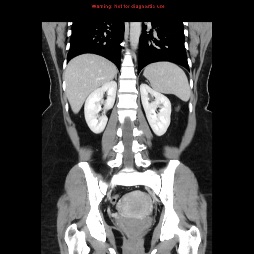 Appendiceal mucinous cystadenoma (Radiopaedia 8263-9111 B 50).jpg