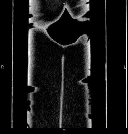 Appendiceal mucocele (Radiopaedia 83147-97518 C 70).jpg