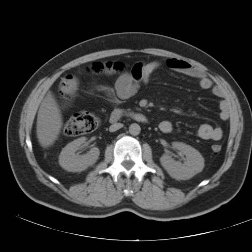 Appendicitis and giant appendicolith (Radiopaedia 80251-93588 Axial non-contrast 23).jpg