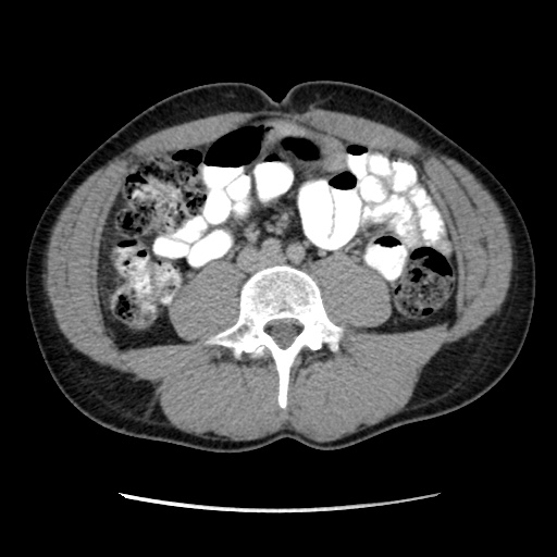 Appendicitis complicated by post-operative collection (Radiopaedia 35595-37113 A 42).jpg