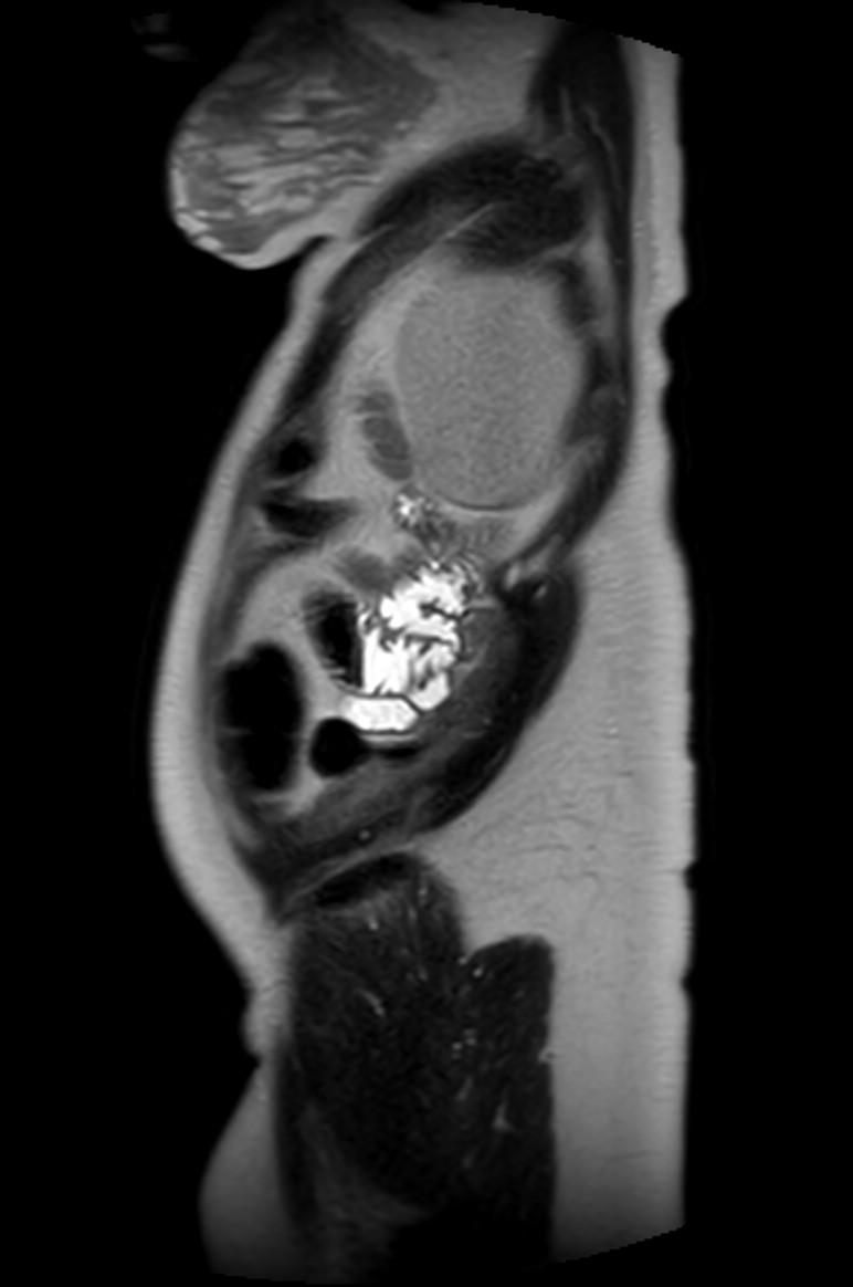 Appendicitis in gravida (MRI) (Radiopaedia 89433-106395 Sagittal T2 8).jpg