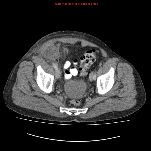 File:Appendicitis mass in inguinal hernia (Radiopaedia 26858-27029 A 20).jpg