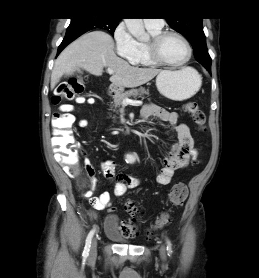 Appendicitis with localized perforation and abscess formation (Radiopaedia 49035-54130 B 19).jpg
