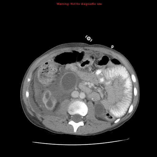 Appendicitis with phlegmon (Radiopaedia 9358-10046 A 35).jpg