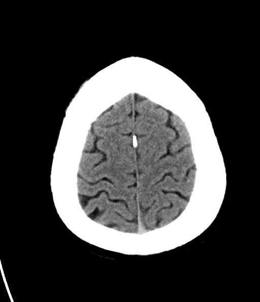 File:Aqueduct stenosis with corpus callosum hypoattenuation post shunting (Radiopaedia 37212-38973 Axial non-contrast 28).png
