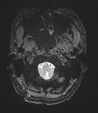 Arachnoid cyst with subdural hematoma (Radiopaedia 85892-101743 Axial SWI 2).png