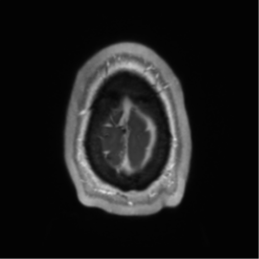 Arachnoid cyst with subdural hematoma (Radiopaedia 85892-101743 Axial T1 C+ 78).png