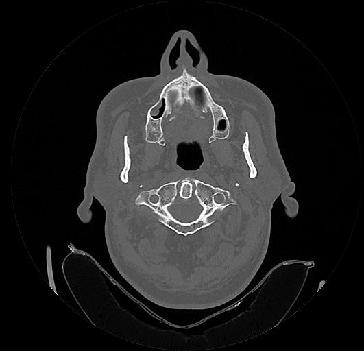 Arcuate foramen (Radiopaedia 89833-106944 Axial bone window 28).jpg