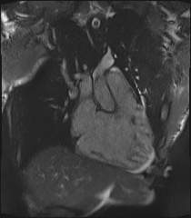 Arrhythmogenic right ventricular cardiomyopathy (Radiopaedia 57972-64966 CINE R2 SSFP 30).jpg