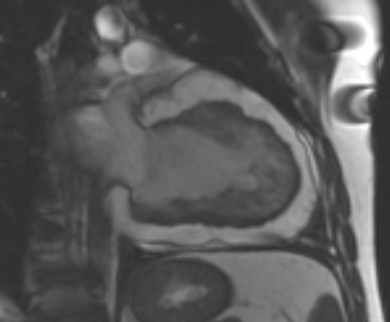 File:Arrhythmogenic right ventricular cardiomyopathy (Radiopaedia 69431-79307 2ch cine 24).jpg