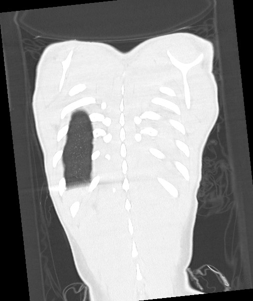 Arrow injury to the chest (Radiopaedia 85367-100975 Coronal lung window 115).jpg