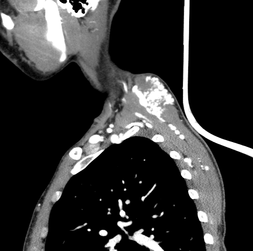 Arteriovenous malformation of the neck (Radiopaedia 53935-60062 C 17).jpg