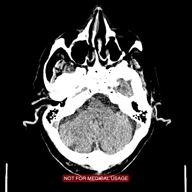 Artery of Percheron infarction (Radiopaedia 28679-28967 Axial non-contrast 27).jpg