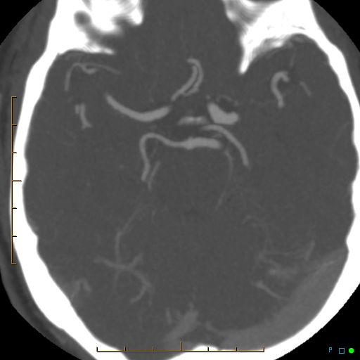 File:Artifactual basilar artery stenosis due to metallic stent (Radiopaedia 31206-31923 A 17).jpg