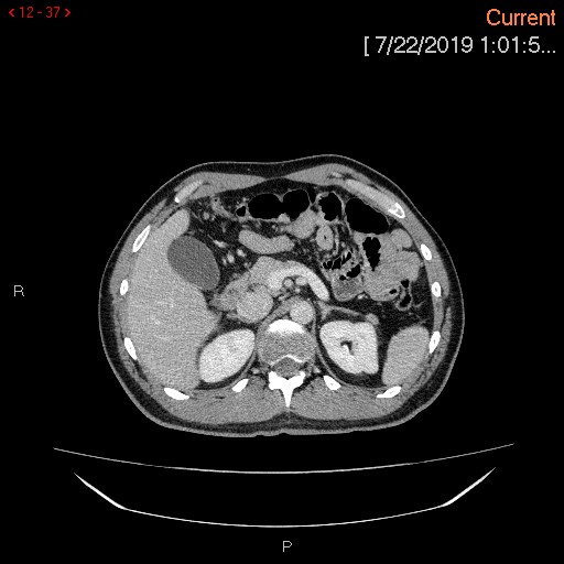 File:Ascending colonic diverticulum mimicking acute appendicitis (Radiopaedia 69943-80198 A 37).jpg