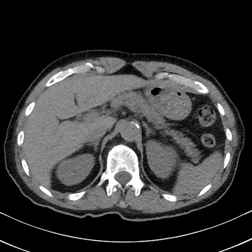Aspergilloma on background pulmonary fibrosis (Radiopaedia 60942-68757 Axial non-contrast 59).jpg
