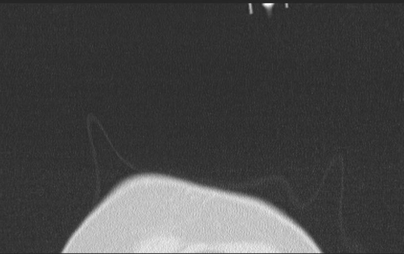 Aspirated tooth (Radiopaedia 28584-28844 Axial lung window 9).jpg