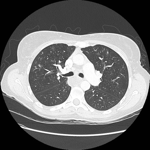 Aspiration pneumonia secondary to laparoscopic banding (Radiopaedia 18345-18183 lung window 41).jpg