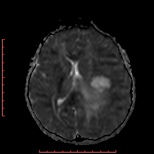 Astroblastoma (Radiopaedia 74287-85162 Axial ADC 35).jpg