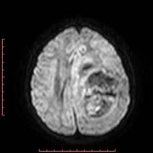 Astroblastoma (Radiopaedia 74287-85162 Axial DWI 69).jpg