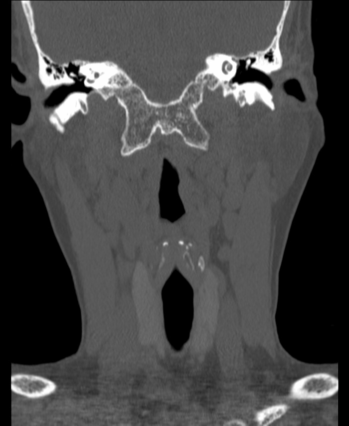 Atlanto-occipital assimilation with basilar invagination (Radiopaedia 70122-80188 Coronal bone window 43).jpg