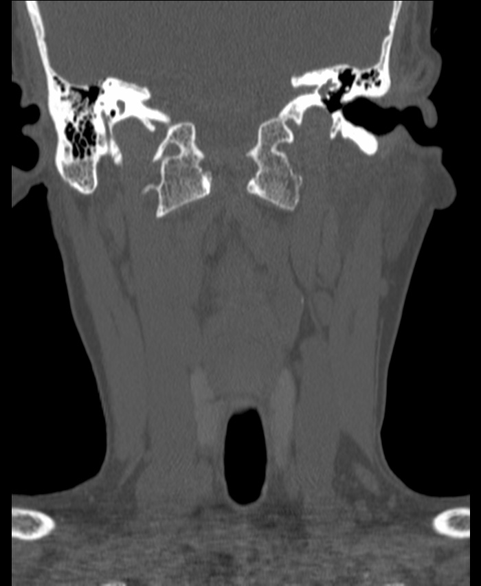 Atlanto-occipital assimilation with basilar invagination (Radiopaedia 70122-80188 Coronal bone window 56).jpg