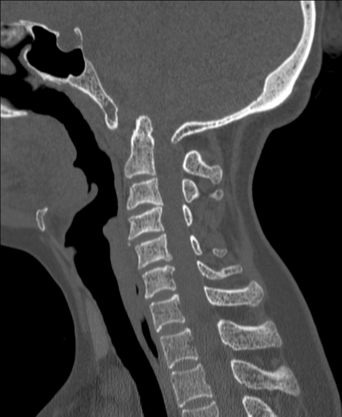 Atlanto-occipital assimilation with basilar invagination (Radiopaedia 70122-80188 Sagittal bone window 70).jpg