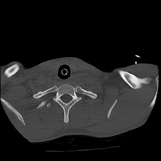 Atlanto-occipital dissociation (Traynelis type 1), C2 teardrop fracture, C6-7 facet joint dislocation (Radiopaedia 87655-104061 Axial bone window 85).jpg