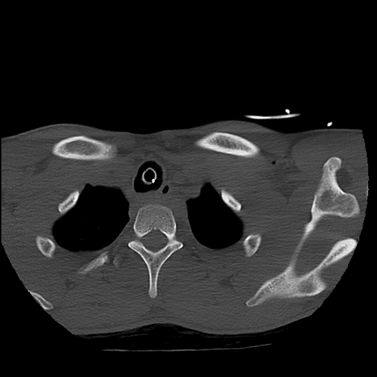 Atlanto-occipital dissociation (Traynelis type 1), C2 teardrop fracture, C6-7 facet joint dislocation (Radiopaedia 87655-104061 Axial bone window 96).jpg