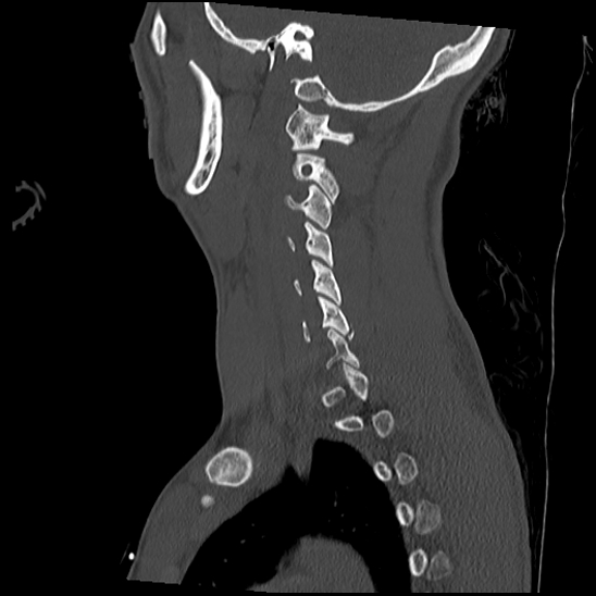 Atlanto-occipital dissociation (Traynelis type 1), C2 teardrop fracture, C6-7 facet joint dislocation (Radiopaedia 87655-104061 Sagittal bone window 48).jpg