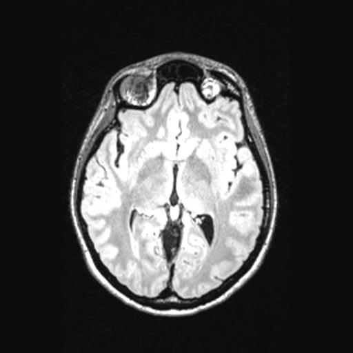 Atretic encephalocoele with inferior vermis hypoplasia (Radiopaedia 30443-31108 Axial 78).jpg