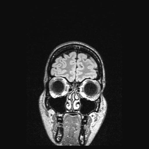 Atretic encephalocoele with inferior vermis hypoplasia (Radiopaedia 30443-31108 Coronal FLAIR 157).jpg