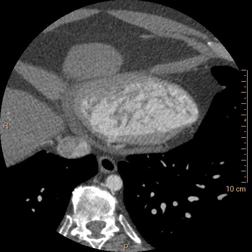 File:Atrial septal defect (upper sinus venosus type) with partial anomalous pulmonary venous return into superior vena cava (Radiopaedia 73228-83961 A 234).jpg