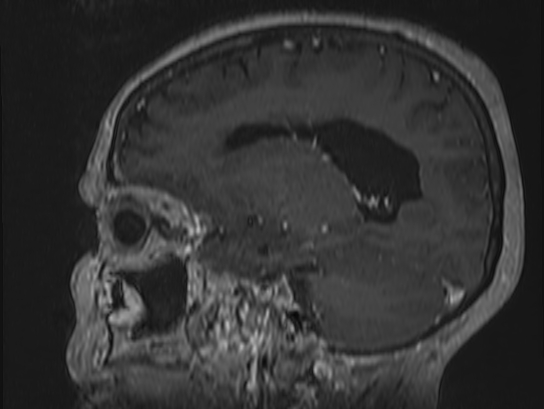 Atypical meningioma (Radiopaedia 62985-71406 Sagittal T1 C+ 29).jpg