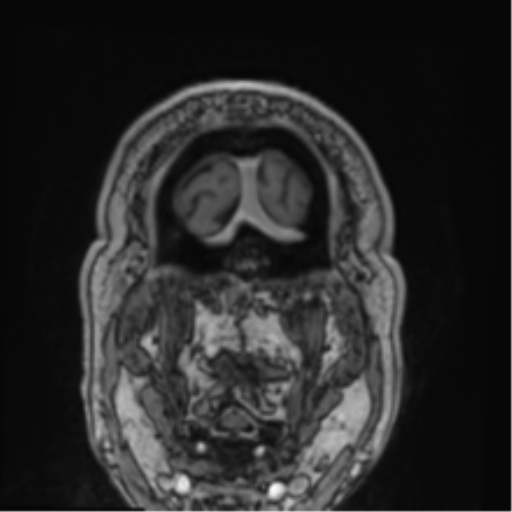 Atypical meningioma (WHO grade II) with brain invasion (Radiopaedia 57767-64729 Coronal T1 C+ 81).png