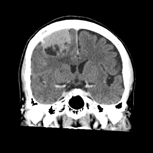 Atypical meningioma (WHO grade II) with osseous invasion (Radiopaedia 53654-59715 Coronal C+ delayed 28).png