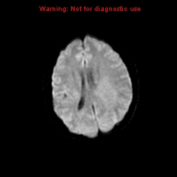 File:Atypical meningioma - grade II (Radiopaedia 13303-13305 Axial DWI 13).jpg