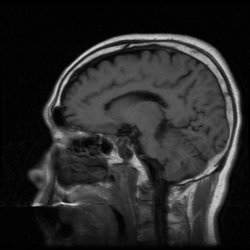 File:Atypical meningioma with skull invasion (Radiopaedia 34357-35648 Sagittal T1 10).png