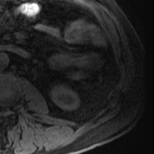 File:Atypical renal cyst on MRI (Radiopaedia 17349-17046 Axial T1 fat sat 28).jpg