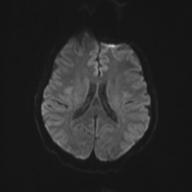 Autoimmune limbic encephalitis (Radiopaedia 30363-31005 Axial B0 and DWI 51).jpg