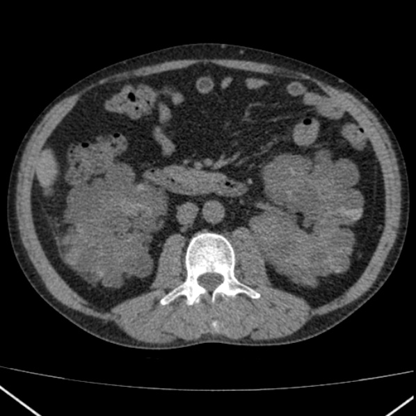 File:Autosomal dominant polycystic kidney disease (Radiopaedia 36539-38101 Axial non-contrast 40).jpg