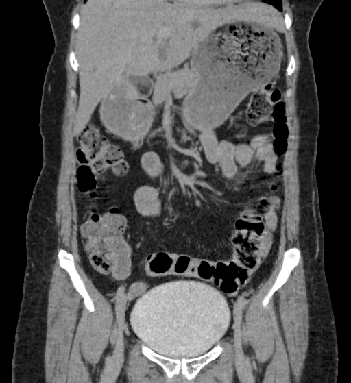 Autosomal dominant polycystic kidney disease (Radiopaedia 38189-40194 Coronal C+ delayed 25).jpg