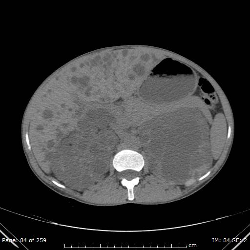 Autosomal dominant polycystic kidney disease (Radiopaedia 44122-47684 Axial non-contrast 30).jpg