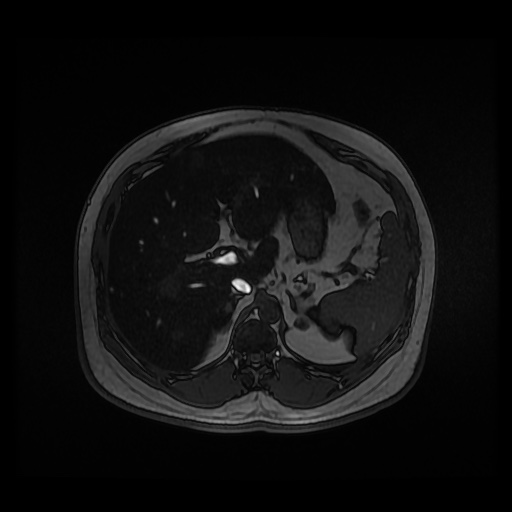 Autosomal dominant polycystic kidney disease (Radiopaedia 50259-55611 Axial 2D Dual Echo 29).jpg