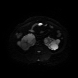 Autosomal dominant polycystic kidney disease (Radiopaedia 50259-55611 Axial DWI 29).jpg