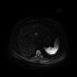 Autosomal dominant polycystic kidney disease (Radiopaedia 50259-55611 Axial DWI 82).jpg