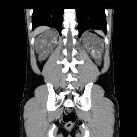 File:Autosomal dominant polycystic kidney disease (Radiopaedia 66349-75582 A 73).jpg