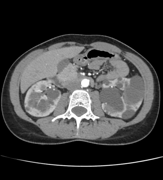 Autosomal dominant polycystic kidney disease - early onset (Radiopaedia 40734-43387 B 28).jpg